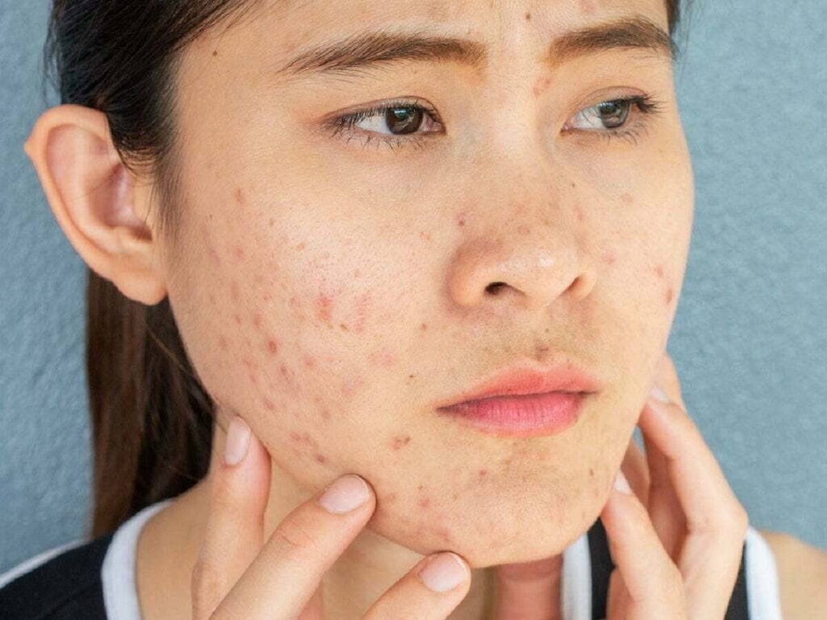 Acne Prevention Simple Tips You Need To Follow To Avoid This Skin 