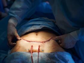 Dehiscence From Body Lift Procedures: Collagen Wound Dressing Can Prevent Rupture Of Wound Edges Dehiscence From Body Lift Procedures: Collagen Wound Dressing Can Prevent Rupture Of Wound Edges