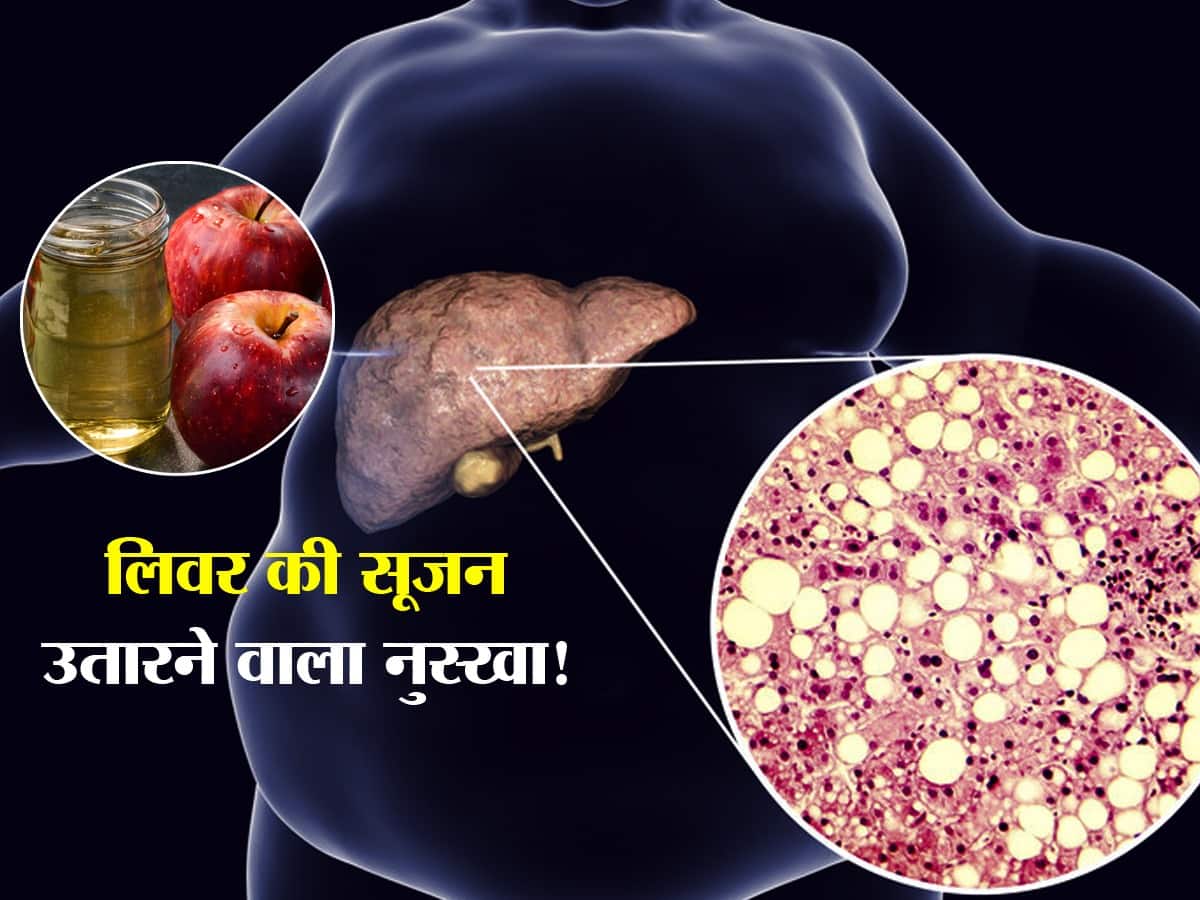 Fatty Liver Natural Treatment लिवर पर सूजन उतारने के लिए इन 3 तरीकों