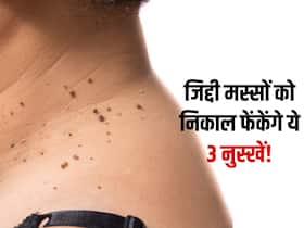 हफ्ते भर में गर्दन के मस्से को निकाल फेकेंगे ये 3 नैचुरल तरीके! जानें जिद्दी मस्सों से राहत पाने के आसान उपाय