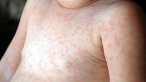 5 Instant Home Remedies For Effective Treatment Of Roseola