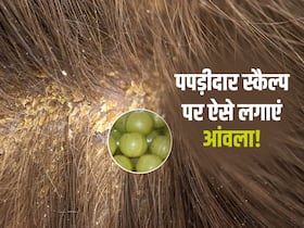 बालों के साथ पपड़ी भी छड़ रही है? स्कैल्प पर लगाएं आंवले के साथ ये 1 चीज, तुरंत मिलेगा आराम