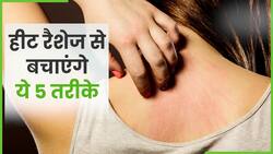 Heat Rashes से हैं परेशान तो अपनाएं ये 5 घरेलू तरीके, Watch Video