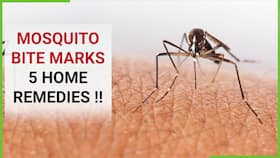 Mosquito Bite Prevention: How To Get Rid Of Red Marks & Itch, Effective Home Remedies For Mosquito Bite, Watch Video