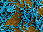Marburg Virus Outbreak: Tanzania And Equatorial Guinea Reports 17 Cases And 5 Deaths