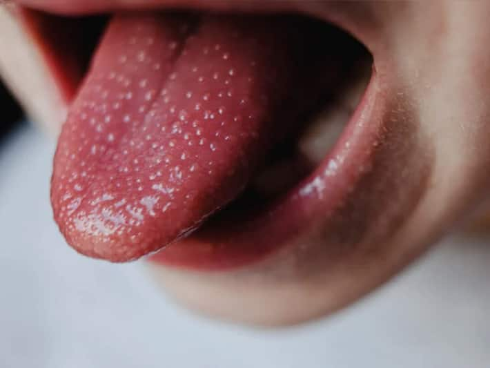 dangerous-vitamin-b12-deficiency-symptoms-on-tongue-thehealthsite