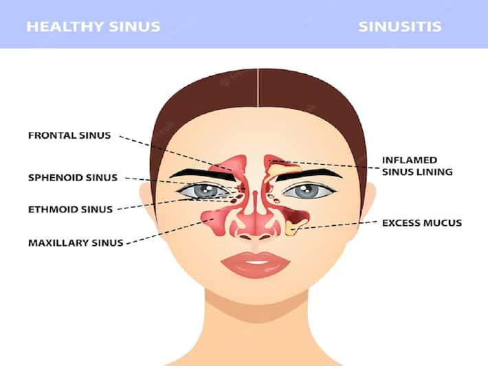 Sinusitis in Children: When Should You Consult The ENT | TheHealthSite.com