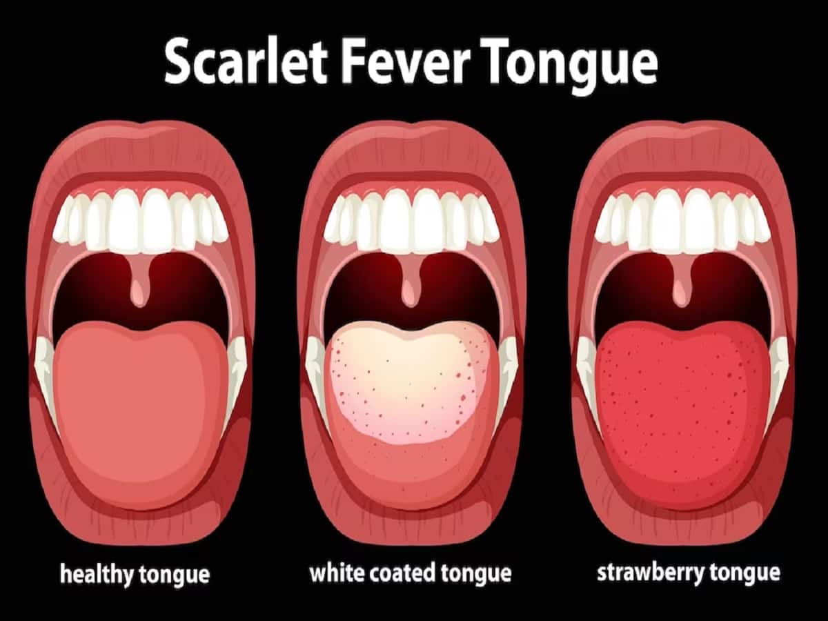 Scarlet Fever: What it Looks Like and What Causes it