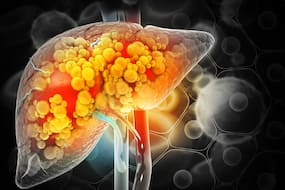 Fatty Liver Disease Symptoms: 5 Signs Your Liver Is At Risk That Can Show Up On Face And Skin Fatty Liver Disease Symptoms: 5 Signs Your Liver Is At Risk That Can Show Up On Face And Skin