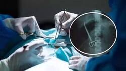 Scissor In Woman's Stomach: How Medical Negligence Left 30-Year-Old Suffer Severe Abdominal Pain For 5 Years