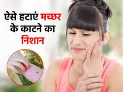 मच्छर के काटने से स्किन नजर आने लगती है भद्दी, इन 4 तरीकों से हटाएं ये निशान