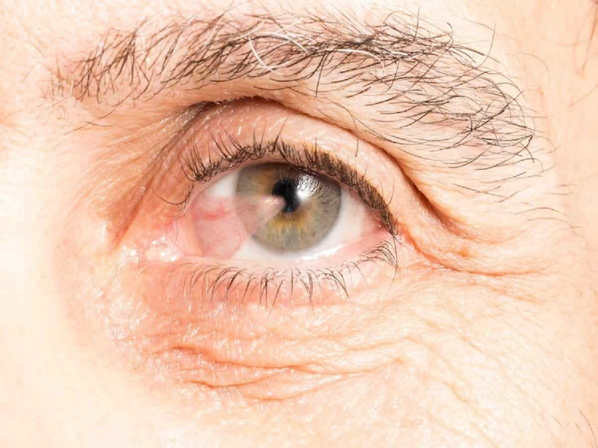 Pterygium Or Surfer's Eye: Get To Know The Causes And Symptoms ...