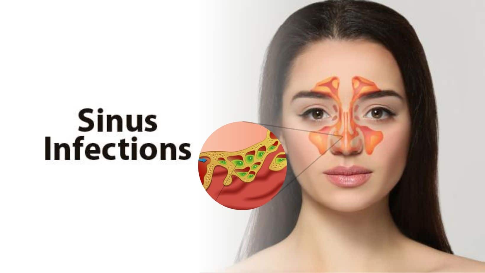 Sinus Infections Are They Contagious Common Myths Busted