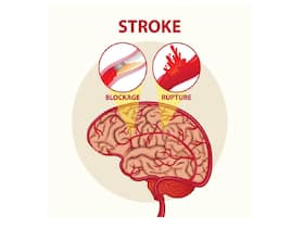 Delhi Man Recovers Miraculously After Suffering Over 100 Mini-Strokes In A Week