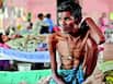 Malnutrition, Stigma, Drug-Resistant TB : Major Challenges For Tuberculosis Control In India