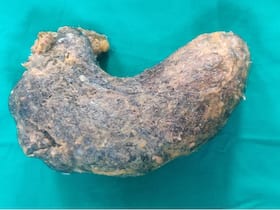 Trichophagia Or Compulsive Eating Of Hair: A 100 Gm Ball Of Hair Removed From A Girl   s Stomach