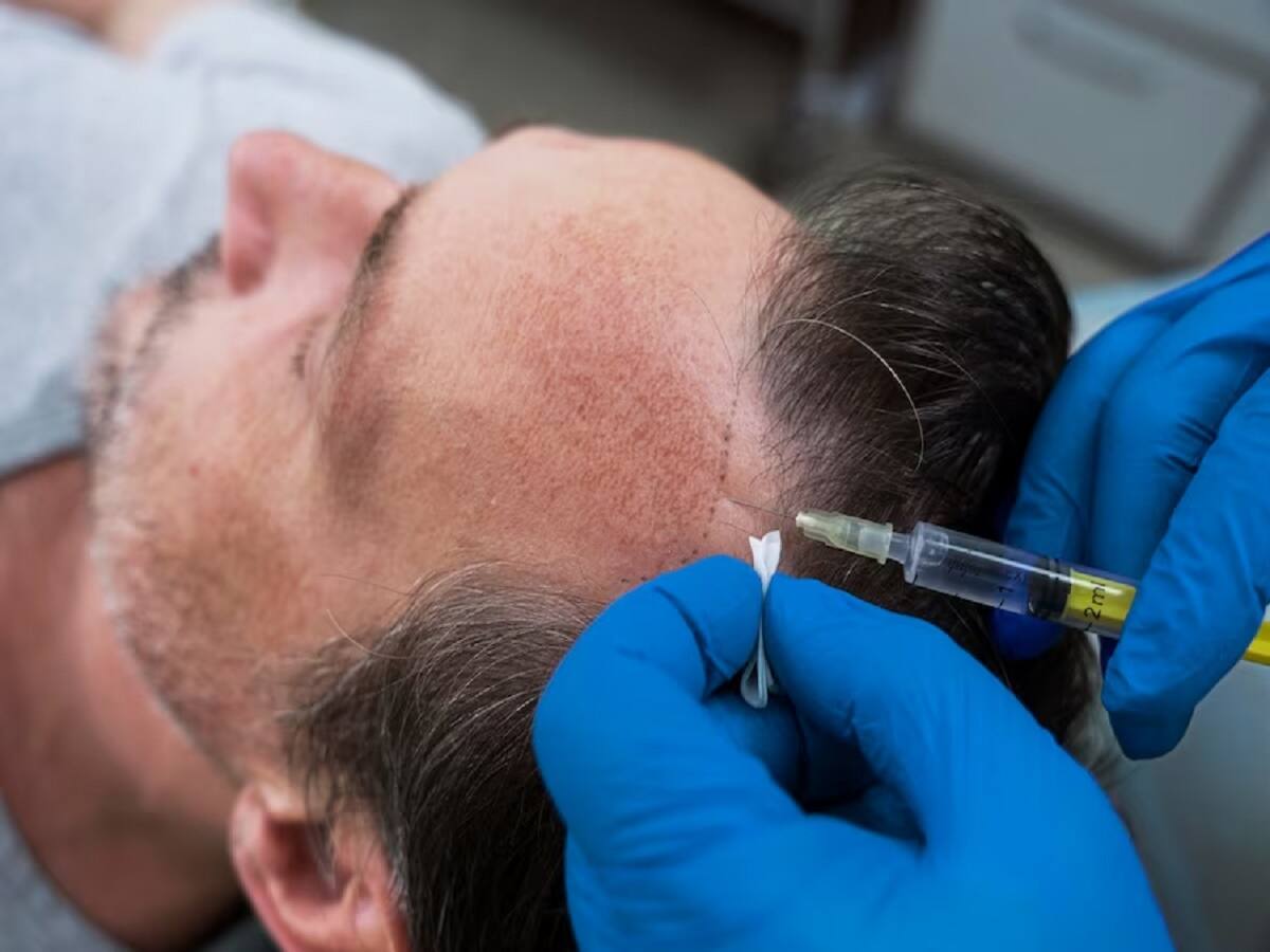 Two most common causes of hair loss: Benefits of GFC therapy - Vimarsana News