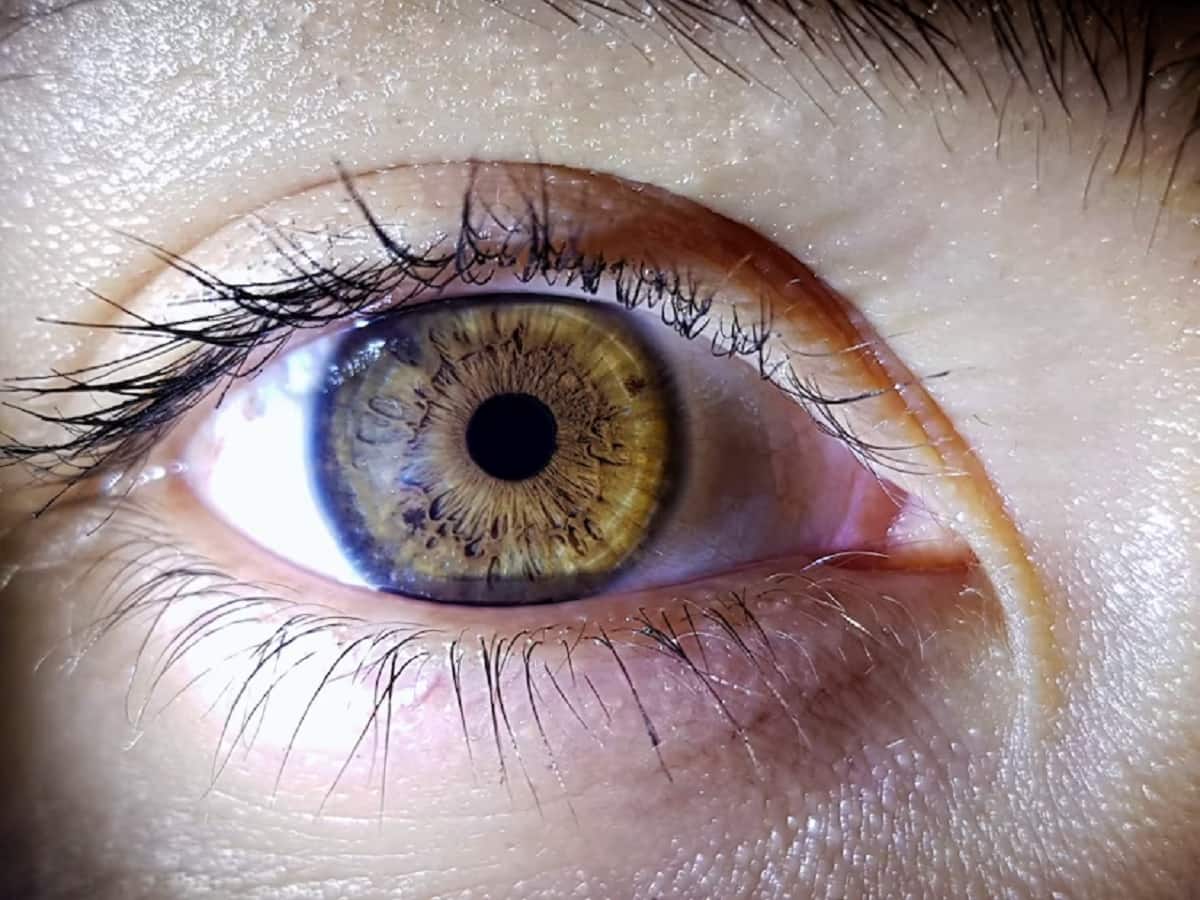 oDocs Eye Care - Posterior synechiae from chronic recurrent anterior  uveitis gives the pupil a funny shape. That's because parts of the pupil  are adhered to the anterior surface of the lens. #