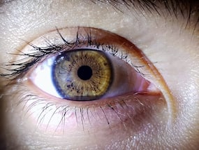 World Glaucoma Week: Eye Surgeon Debunks Myths About Glaucoma