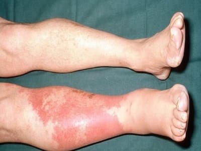 Obesity, Diabetes Can Increase Risk Of Cellulitis And Other Skin Infections