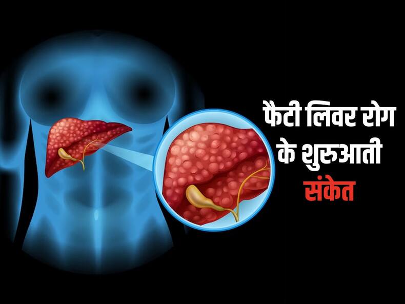 फैटी लिवर होने पर सबसे पहले शरीर के इन 3 भागों में महसूस होता है दर्द, जानिए कब दिखते हैं फैटी लिवर के लक्षण