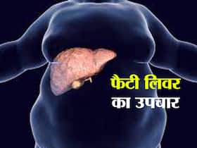 इन 4 तरीकों से अपने आप ठीक हो जाता है लिवर पर जमा फैट! जानिए फैटी लिवर का प्राकृतिक उपचार