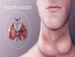 Hypothyroidism: How To Reverse Underactive Thyroid Naturally?
