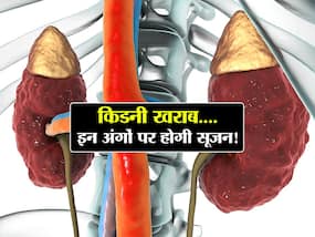 शरीर के इन 4 अंगों पर सूजन है किडनी रोग का शुरुआती संकेत! इस तरह पता लगाएं खराब होने लगी हैं दोनों किडनियां शरीर के इन 4 अंगों पर सूजन है किडनी रोग का शुरुआती संकेत! इस तरह पता लगाएं खराब होने लगी हैं दोनों किडनियां