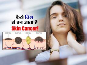 Skin cancer भी बन सकता है आपकी त्वचा पर बना ये मामूली का तिल, डॉक्टर से जानें कैसे करें इसकी पहचान