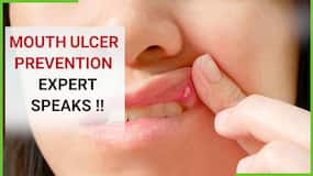 Mouth Ulcer Prevention: How To Cure Ulcers By Following These Basic Tips, Expert Speaks, Watch Video
