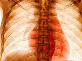 Bone And Spine TB: ISIC s Dr Vikas Tandon Reveals The Complications Of Skeletal Tuberculosis Bone And Spine TB: ISIC s Dr Vikas Tandon Reveals The Complications Of Skeletal Tuberculosis