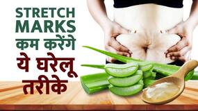 Stretch Marks Home Remedies: इन घरेलू तरीकों से कम होंगे आपके Stretch Marks