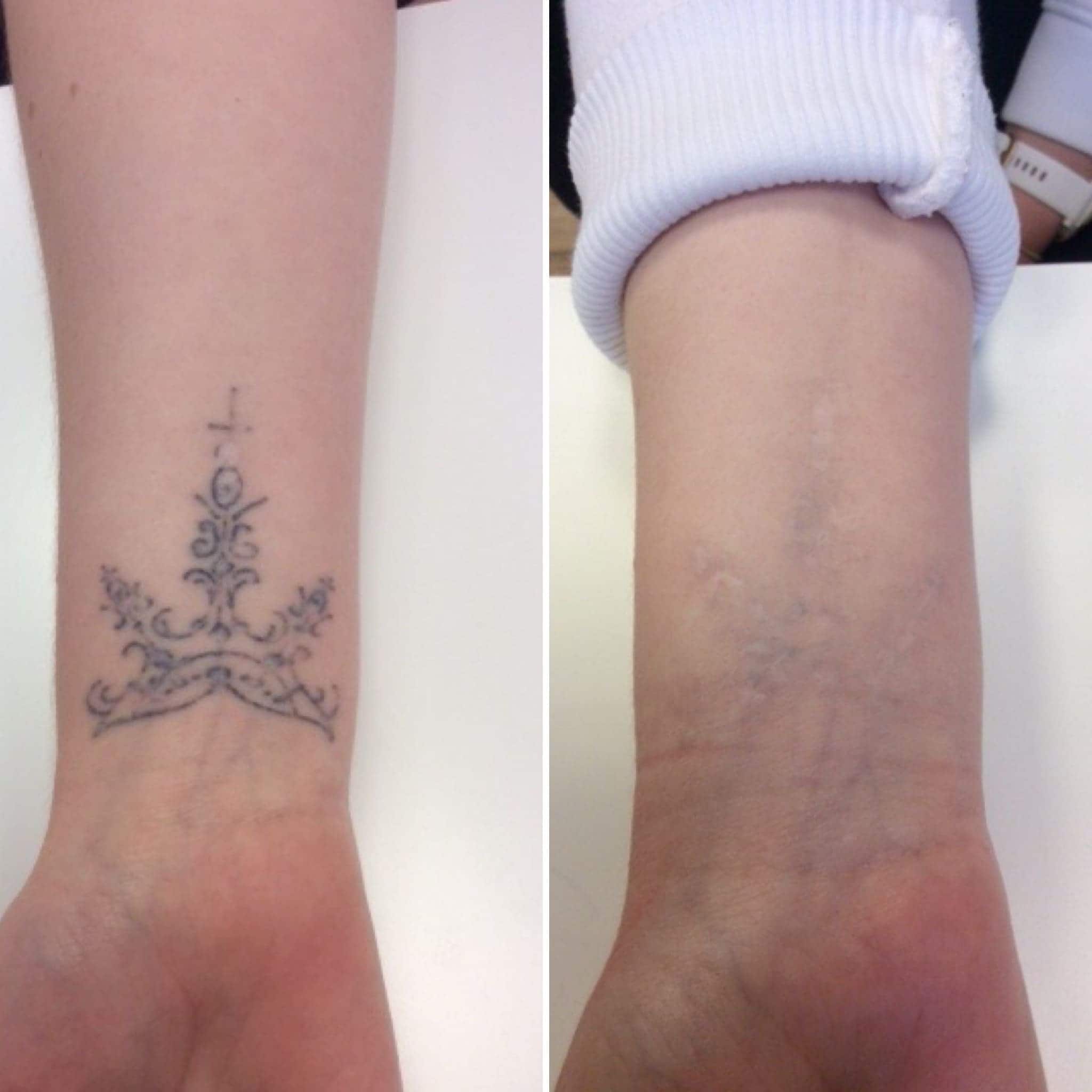 Permanent Tattoo Removal  Simply Better Skin