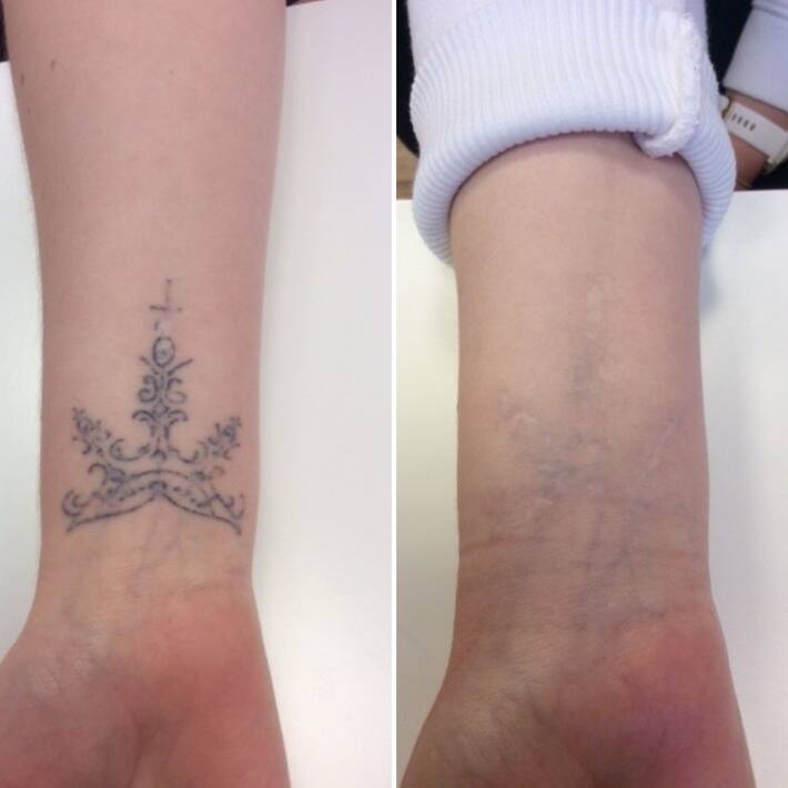 7 Best Ways To Remove Permanent Tattoos