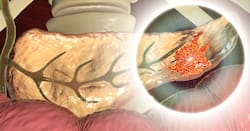 7 Unusual Symptoms of Pancreatic Cancer Explained By Doctor