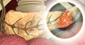 7 Unusual Symptoms of Pancreatic Cancer Explained By Doctor