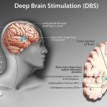 Deep Brain Stimulation