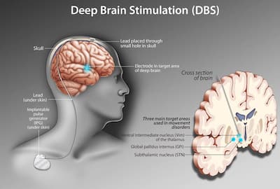 Deep Brain Stimulation For Parkinson's Disease: What Is It, Advantages 