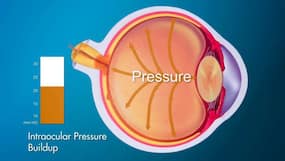 Eye Pressure And Glaucoma: How High Is Too High?