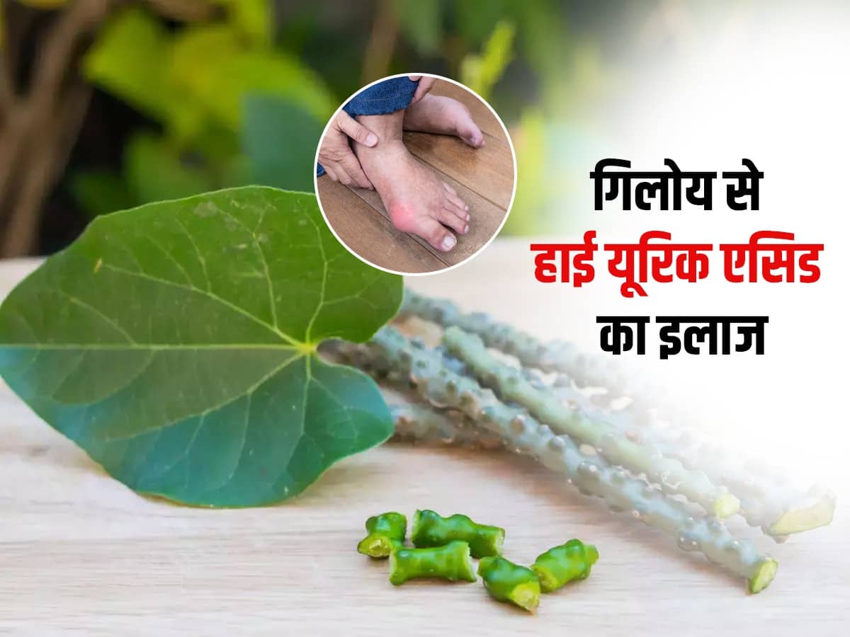Giloy Se Uric Acid Ka Upchar Giloy For Uric Acid हाई यूरिक एसिड से