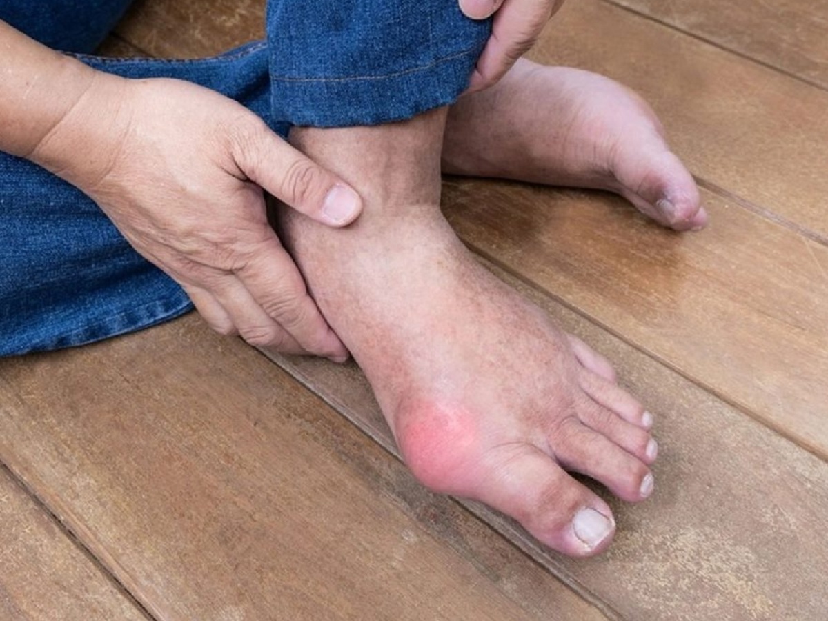 Tips To Manage Gout