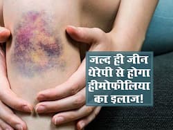 हीमोफीलिया का अब जल्द ही जीन थेरेपी से होगा इलाज, AIIMS के डॉक्टर कर रहे हैं रिसर्च