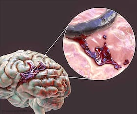 Hemophilia Deaths: How Minor Head Trauma Can Bleed You To Death