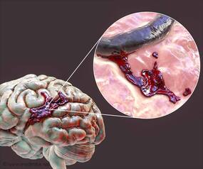 Hemophilia Deaths: How Minor Head Trauma Can Bleed You To Death