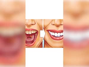 10 Tips To Get Rid Of Tartar In Teeth Naturally