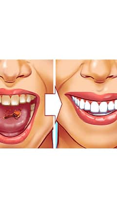 10 Tips To Get Rid Of Tartar In Teeth Naturally