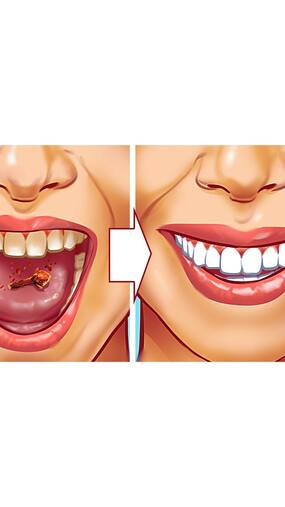 10 Tips To Get Rid Of Tartar In Teeth Naturally