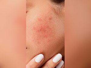 Top 10 Home Remedies For Face Pimples And Marks