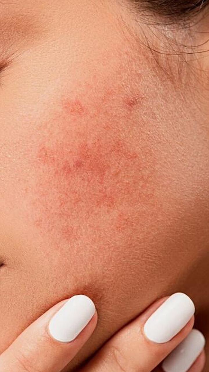 Top 10 Home Remedies For Face Pimples And Marks