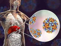 Liver Cancer Symptoms: 5 Warning Signs of Hepatocellular Carcinoma You Shouldn't Ignore